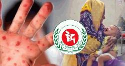 হামের উপসর্গে আরও ৮ শিশুর মৃত্যু, নতুন আক্রান্ত ১০৩৯