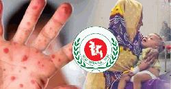 হামের উপসর্গে আরও ৫ জনের মৃত্যু, নতুন রোগী ১০৩১