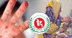হাম উপসর্গে আরও ৭ শিশুর মৃত্যু